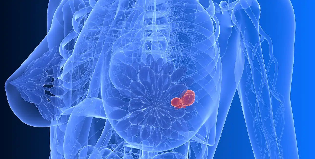 Breast Cancer Dendritic Vaccine in Germany