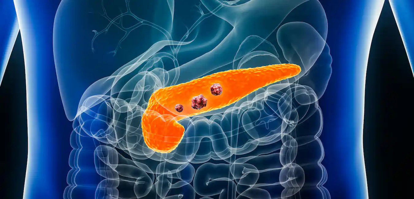 Pancreatic cancer treatment in Germany